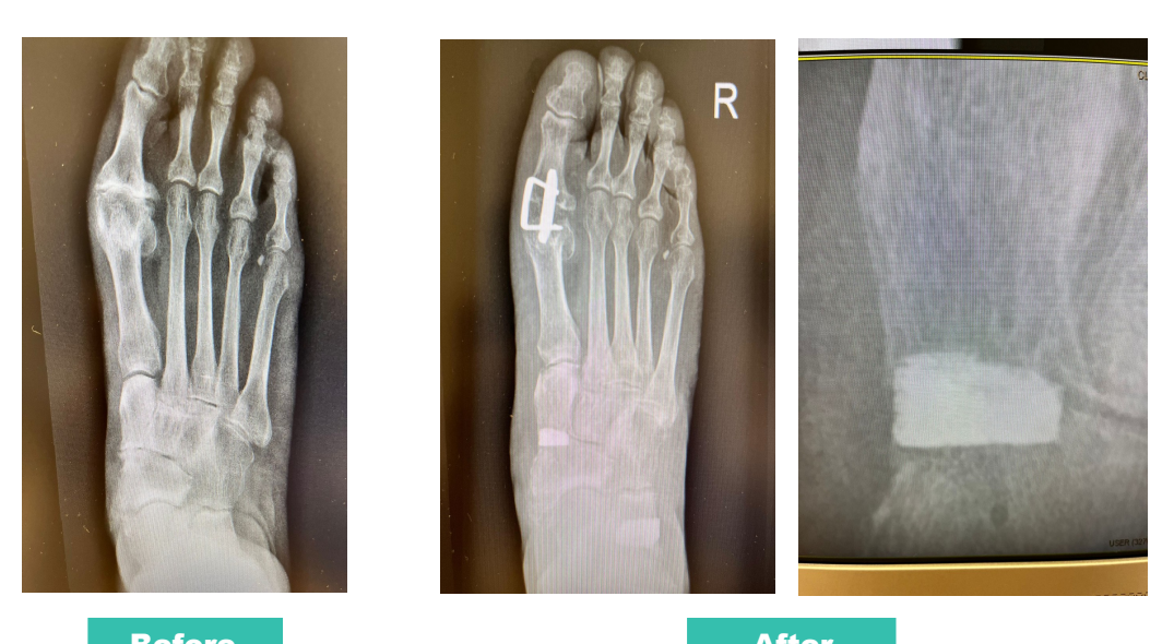 OsteoSinter® EVANS și COTTON — radiografii înainte/după corecția chirurgicală a deformității piciorului (caz clinic AMES Medical)