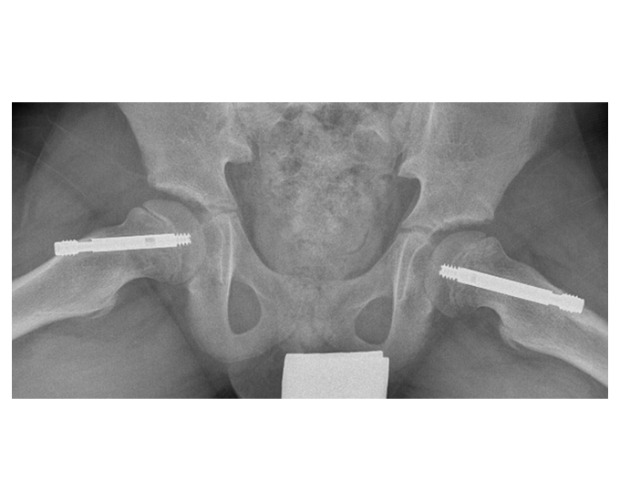 Radiografie: fixare bilaterală de șold cu șurub Free Gliding SCFE