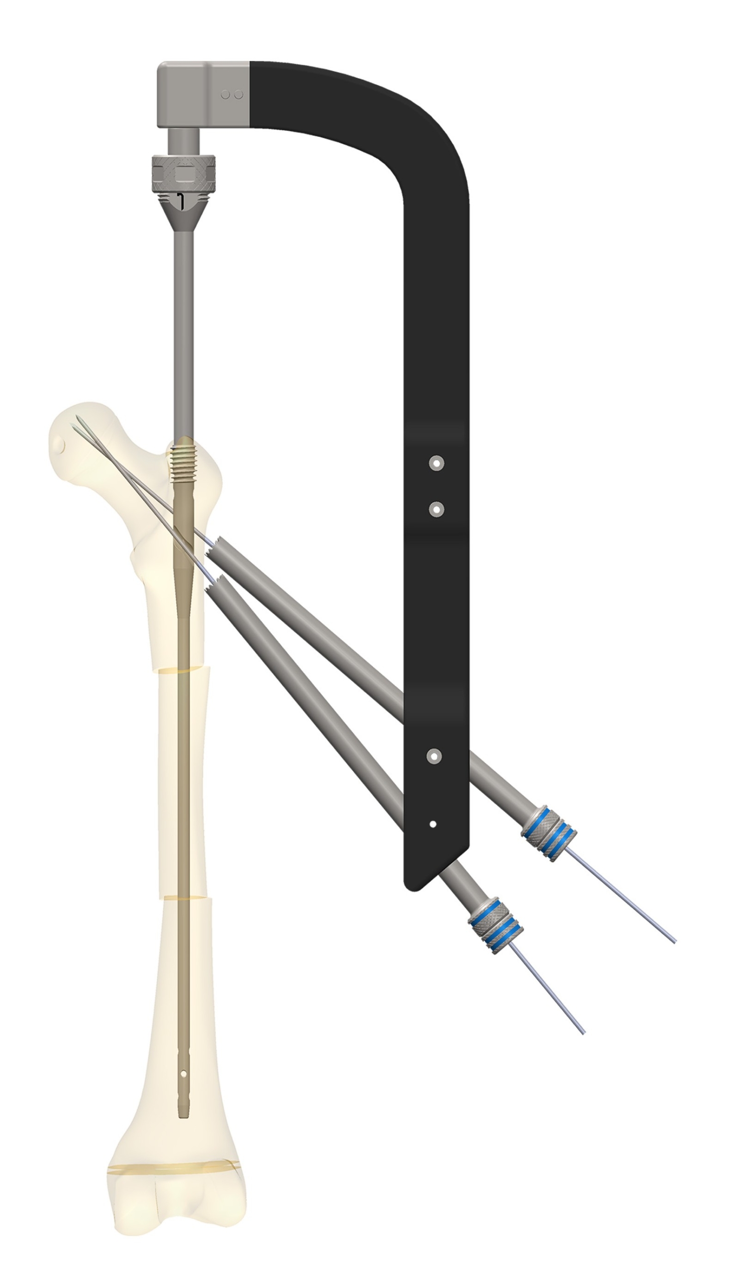 Sistemul GAP Nail — tijă centromedulară endo-exo cu instrumentar de ghidaj (render)