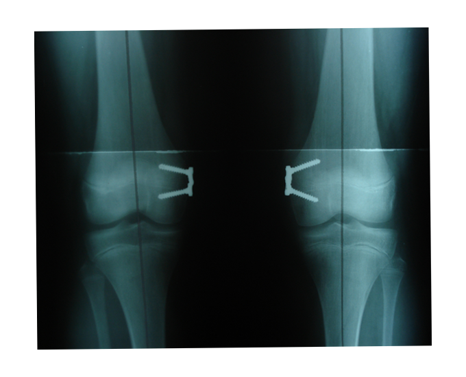 Radiografie: Hinge Plate aplicată bilateral la nivelul genunchilor