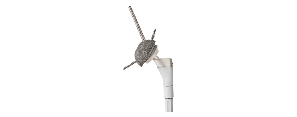 MUTARS® Femur Proximal — componentă modulară (render oficial Implantcast)
