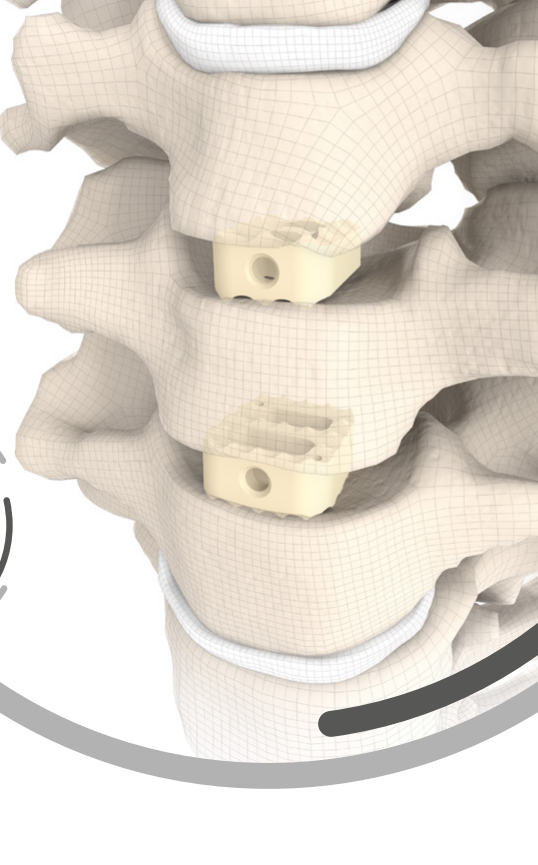 NUBIC® — cage implantat în coloana cervicală prin tehnica Smith–Robinson (render anatomic SIGNUS)