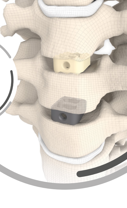 RABEA® — cage implantat în coloana cervicală prin tehnica Smith–Robinson (render anatomic SIGNUS)