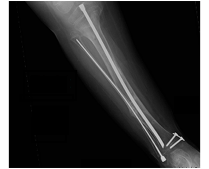 Radiografie clinică: fixare cu tijă SLIM la nivelul tibiei