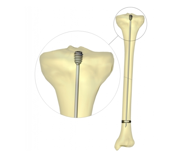 Tija SLIM poziționată în tibie, cu detaliu al capului filetat (model 3D)