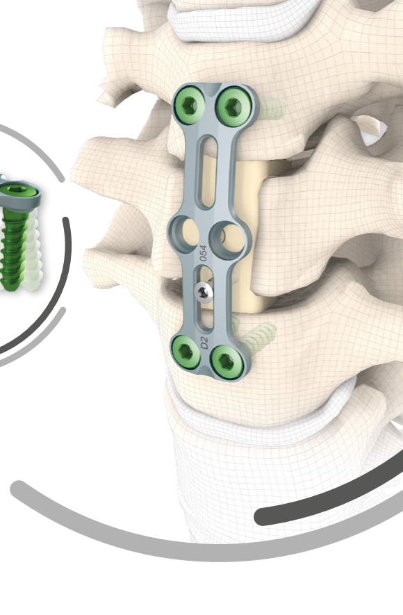 TOSCA® — placă de stabilizare cervicală anterioară fixată cu șuruburi pe coloana cervicală (render anatomic SIGNUS)